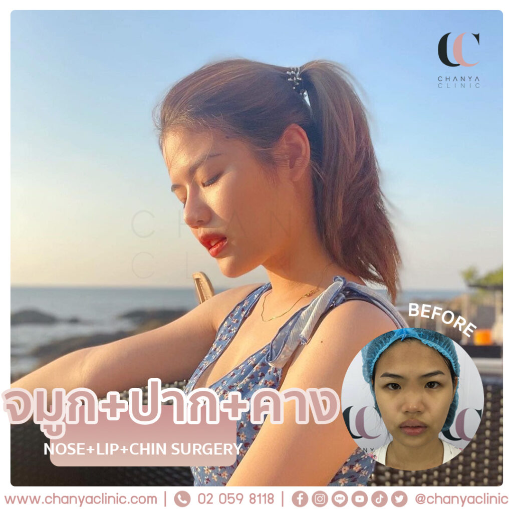 รีวิวการเสริมคาง​ Chanya Clinic