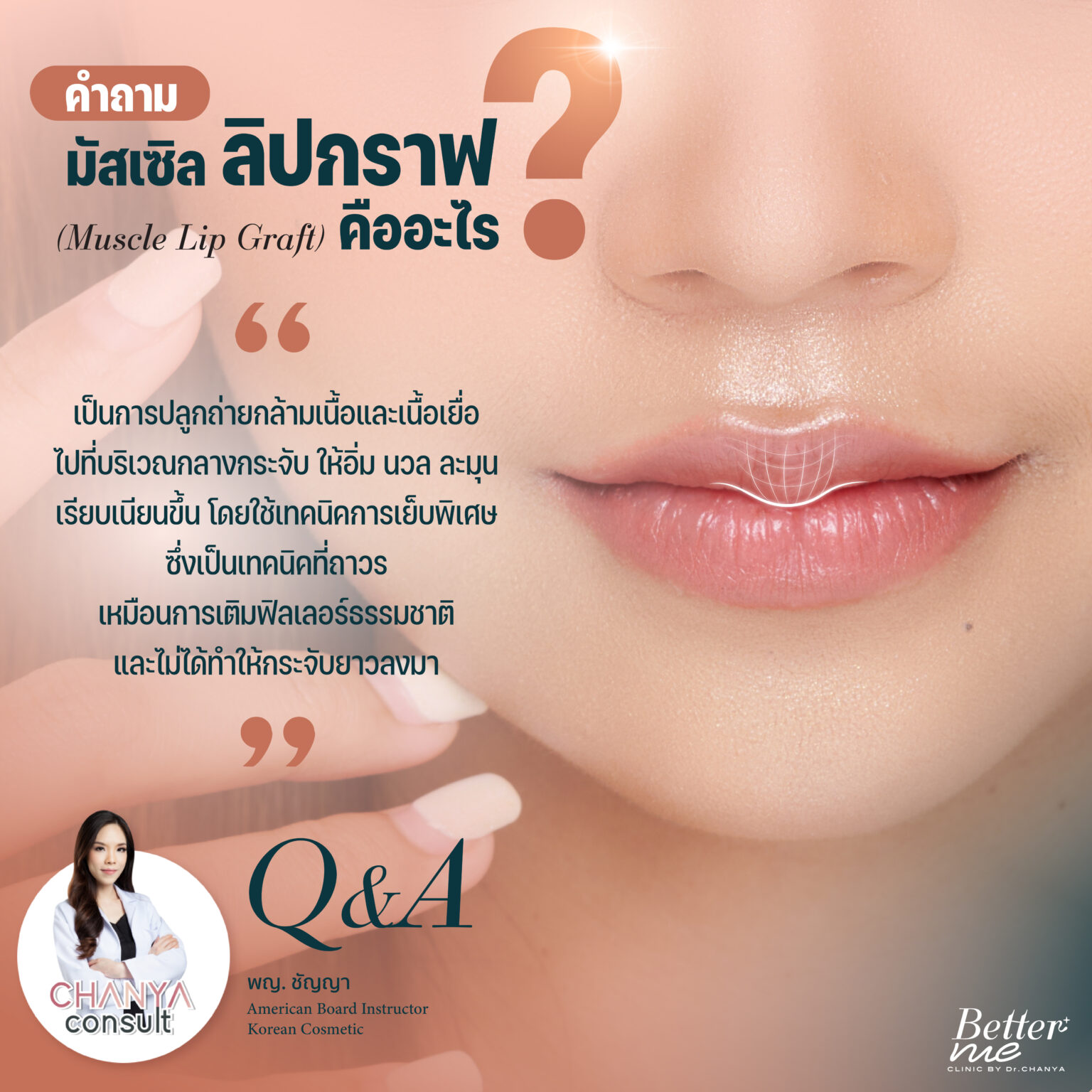 มัสเซิล ลิปกราฟ คืออะไร