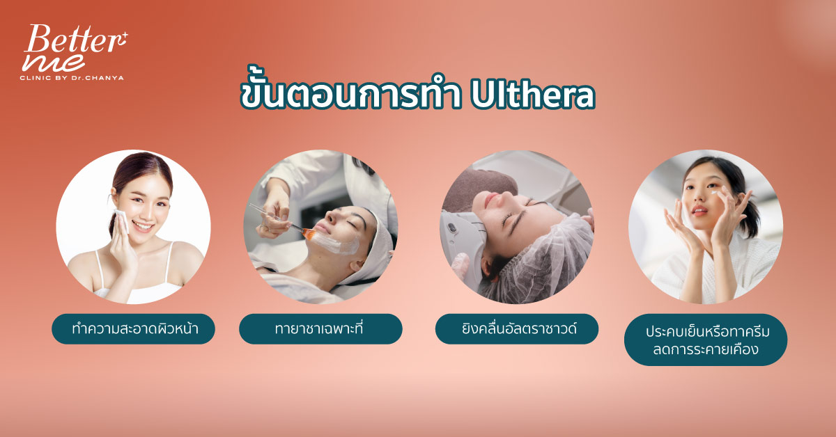 ขั้นตอนการทำ Ulthera