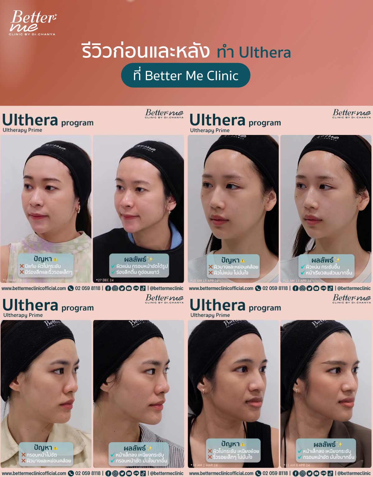 รีวิวก่อนและหลังทำ Ulthera ที่ Better Me Clinic