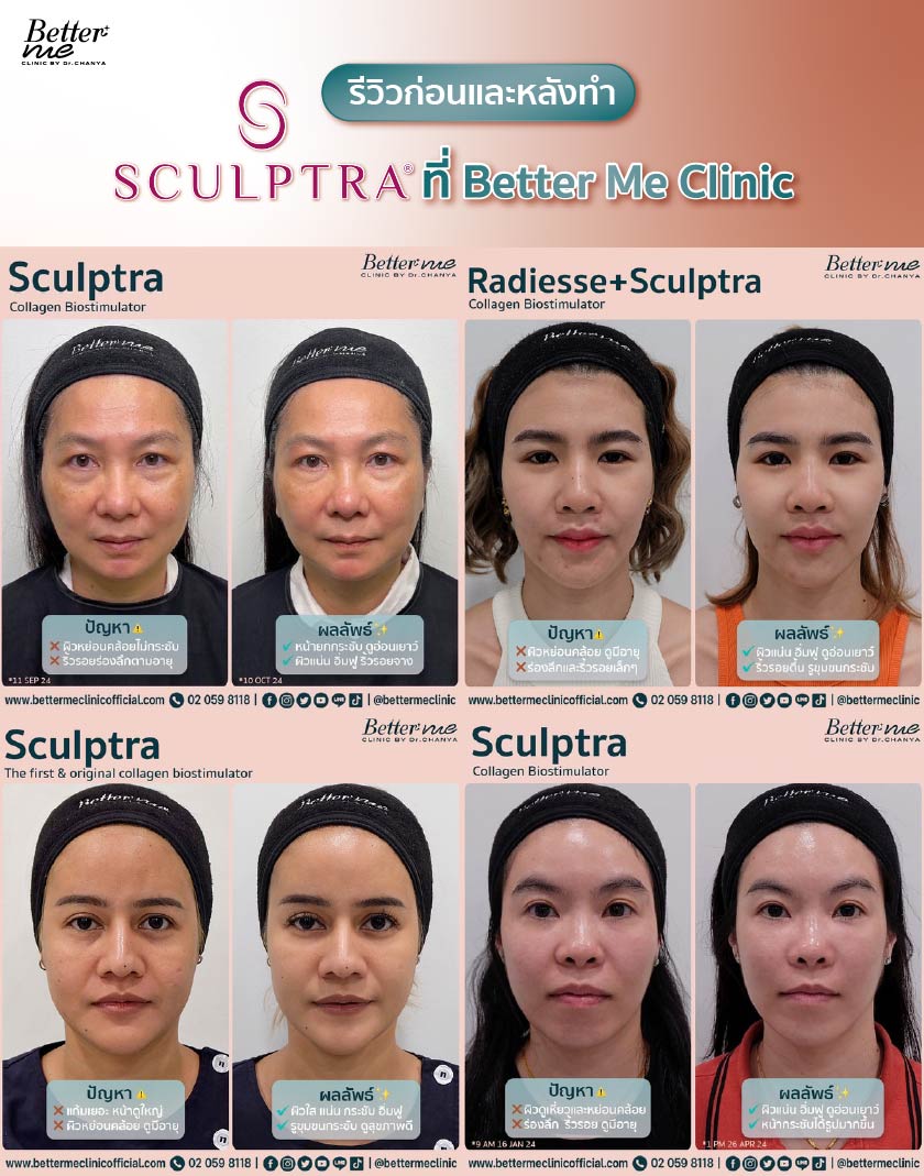 รีวิวก่อนและหลังทำ Sculptra ที่ Better Me Clinic