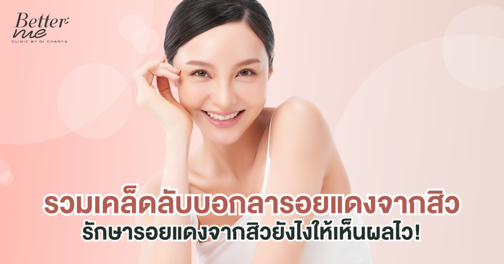 รวมเคล็ดลับบอกลารอยแดงจากสิว รักษารอยแดงจากสิวยังไงให้เห็นผลไว!