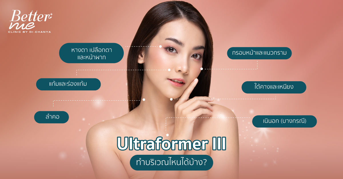 Ultraformer III ทำบริเวณไหนได้บ้าง?