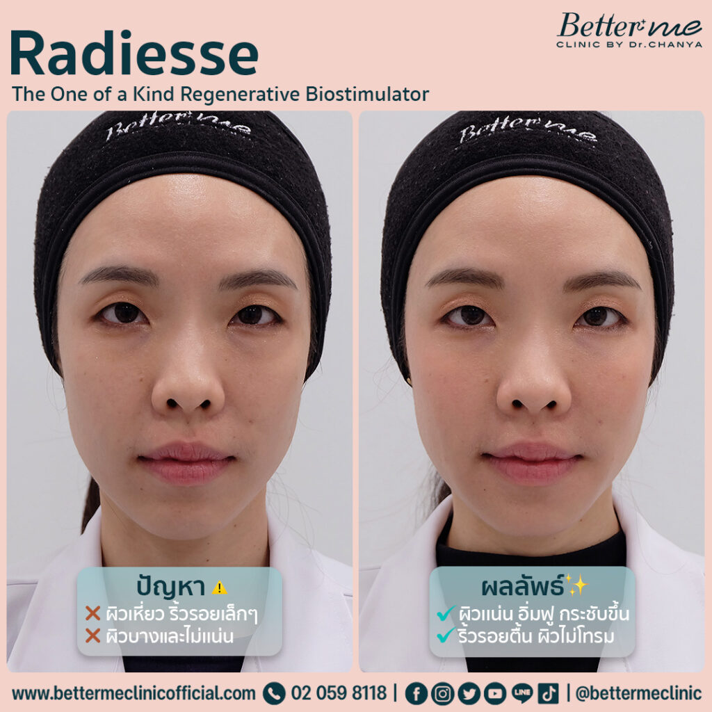 รีวิวการฉีด Radiesse