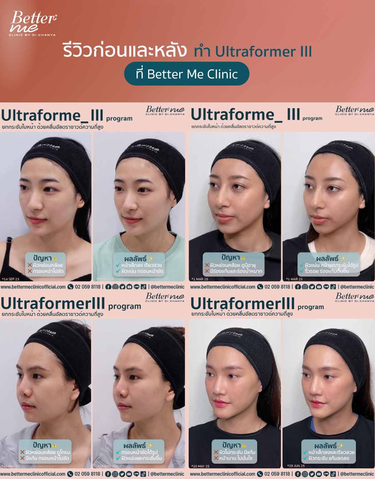 รีวิวก่อนและหลังทำ Ultraformer III ที่ Better Me Clinic
