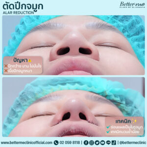 ตัดปีกจมูก