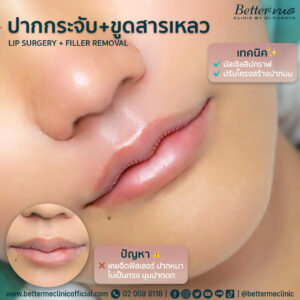 รีวิวปากกระจับ