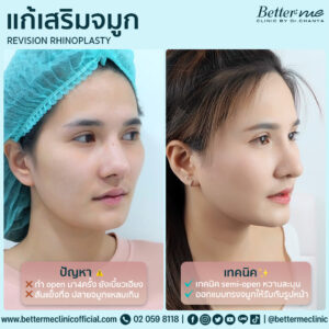 แก้เสริมจมูก