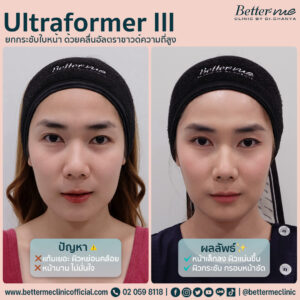Ultraformer III