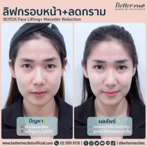 ลดริ่่วรอย