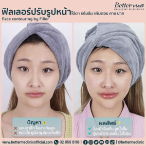 ฟิลเลอร์ปรับรูปหน้า