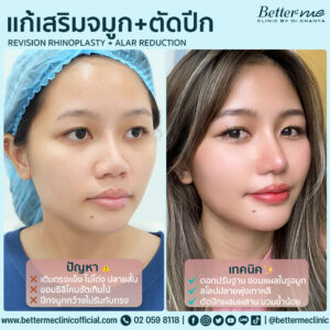 แก้เสริมจมูก