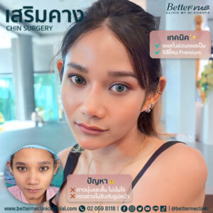 เสริมคาง