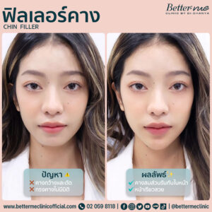 ฟิลเลอร์คาง