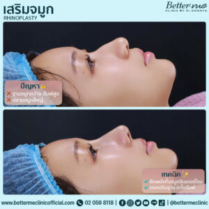 เสริมจมูก