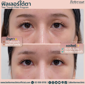 ฟิลเลอร์ใต้ตา