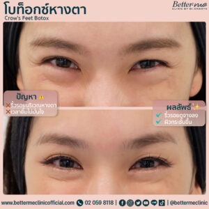 ลดริ่่วรอย