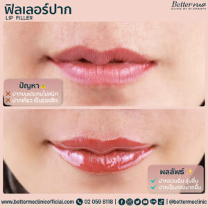 ฟิลเลอร์ปาก