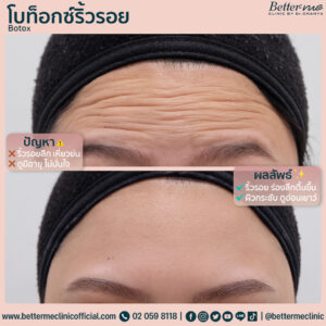 ลดริ่่วรอย