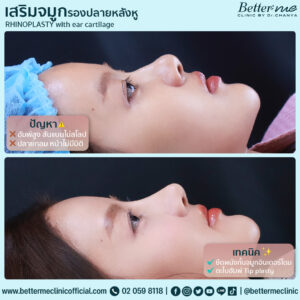 เสริมจมูก