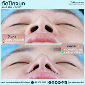 ตัดปีกจมูก