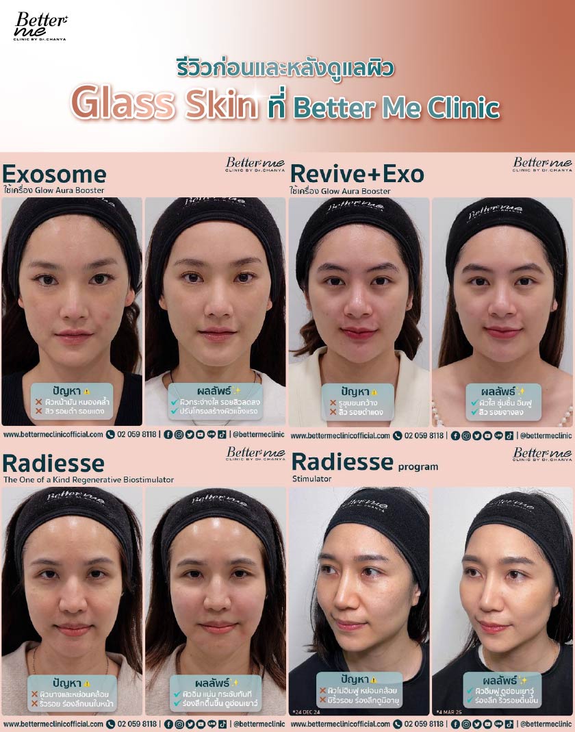 รีวิวก่อนและหลังดูแลผิว Glass Skin ที่ Better Me Clinic