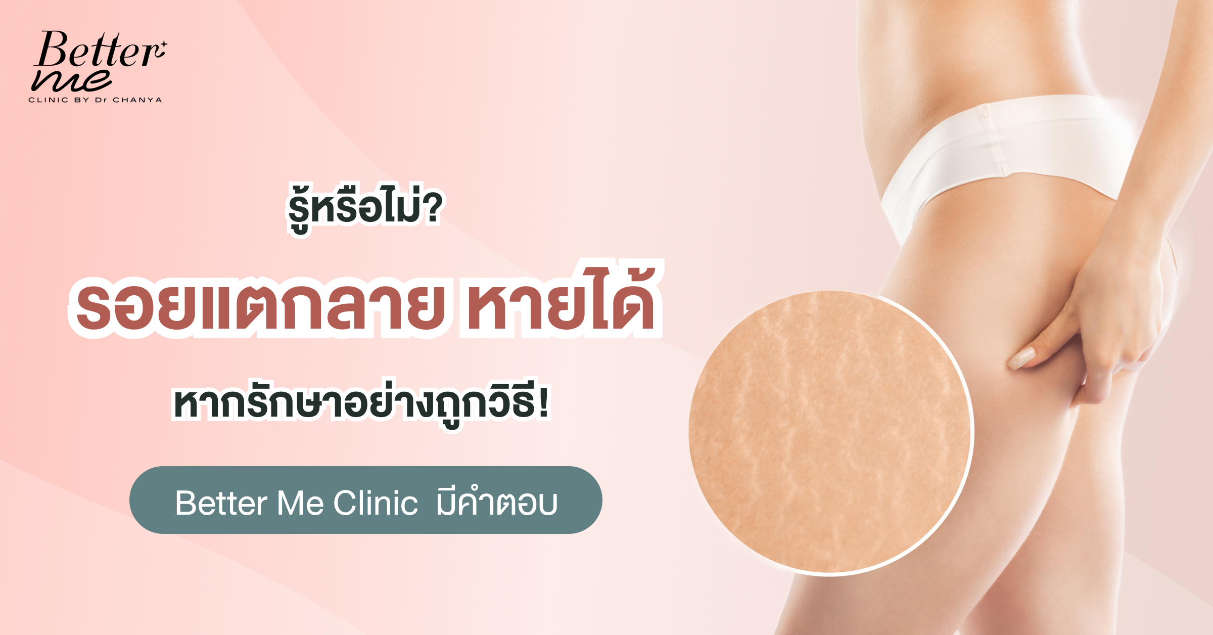รอยแตกลายไม่ใช่ปัญหา! เผยวิธีลดรอยแตกลายให้เห็นผล