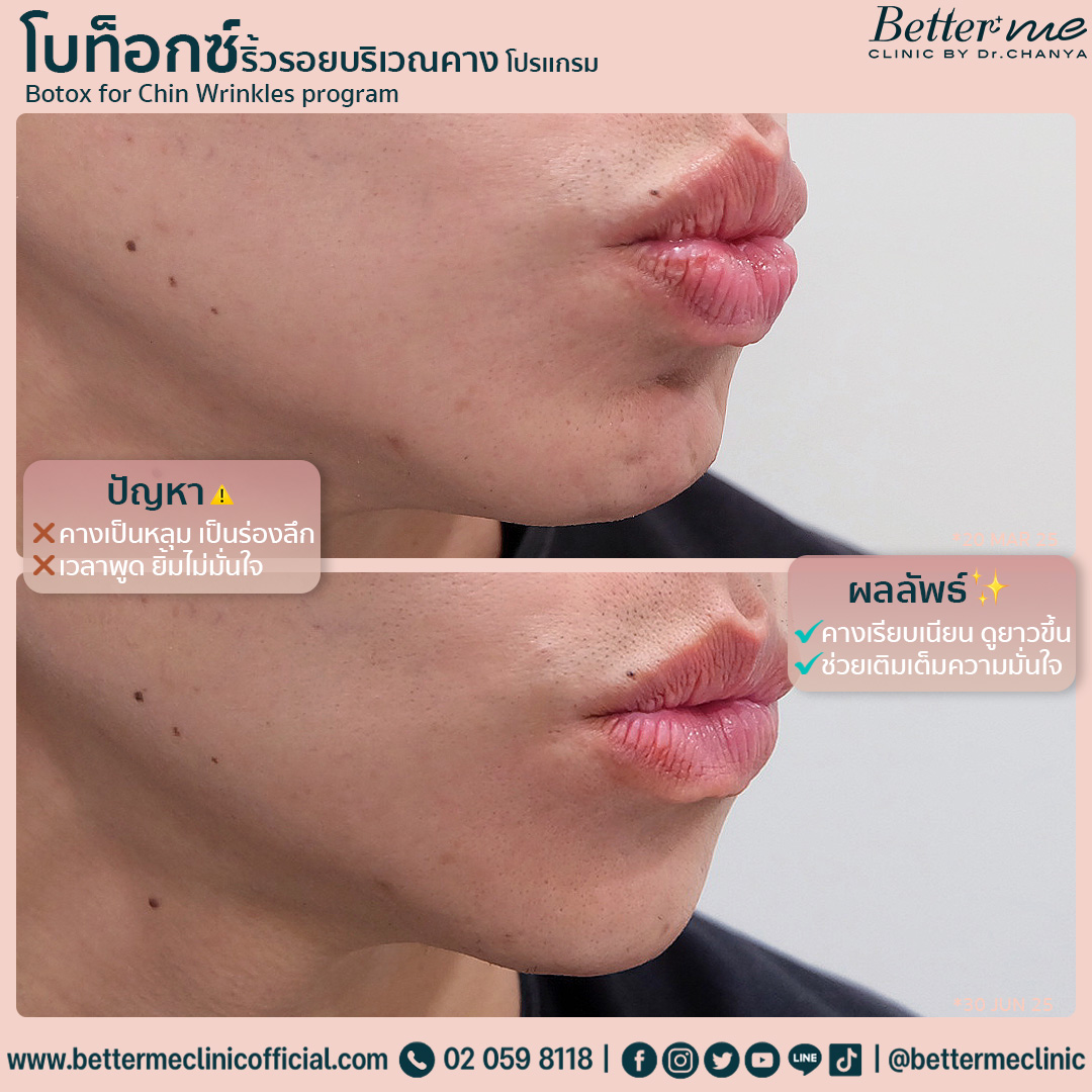 โปรแกรมโบท็อกซ์