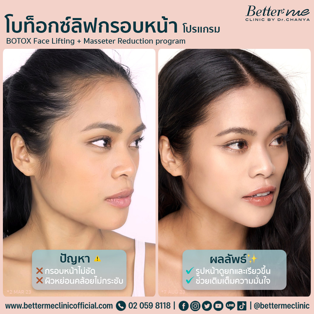 โปรแกรมโบท็อกซ์