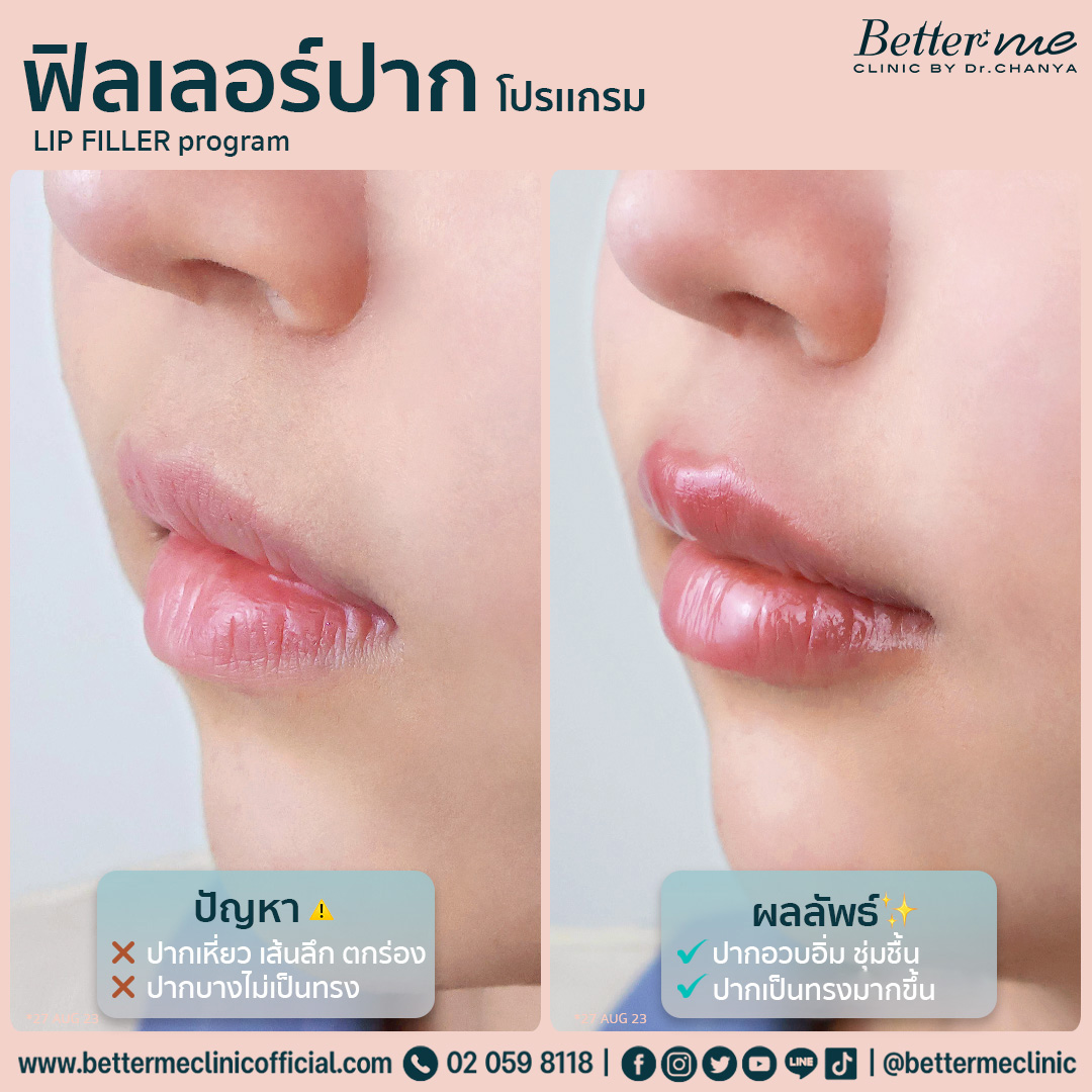 โปรแกรมฟิลเลอร์