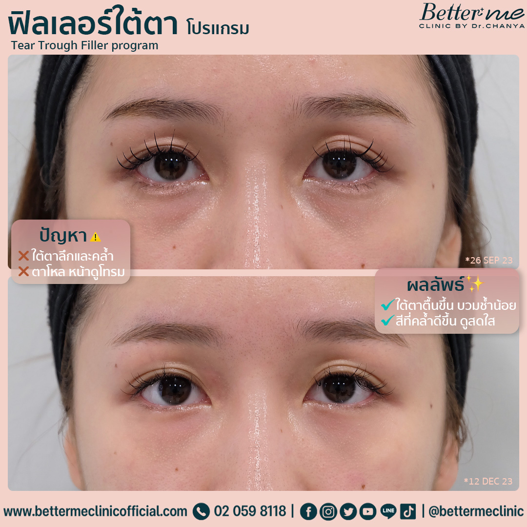 โปรแกรมฟิลเลอร์