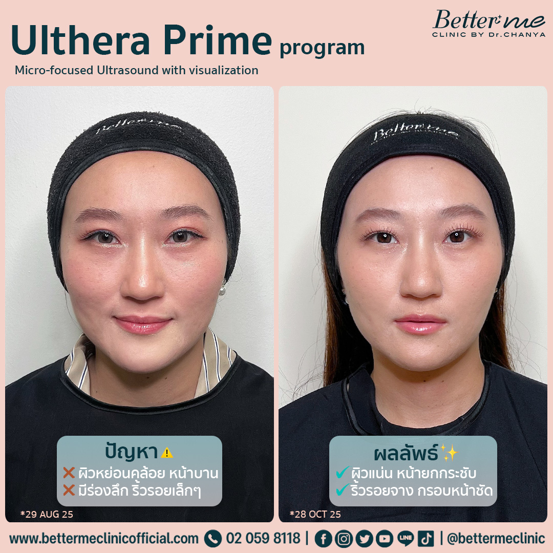 Ulthera prime program