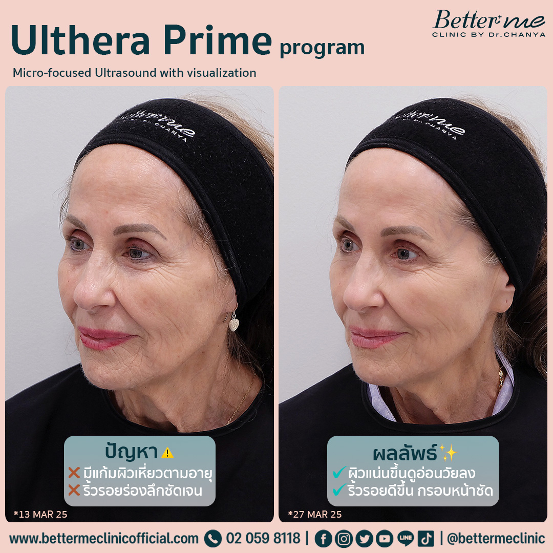 Ulthera prime program