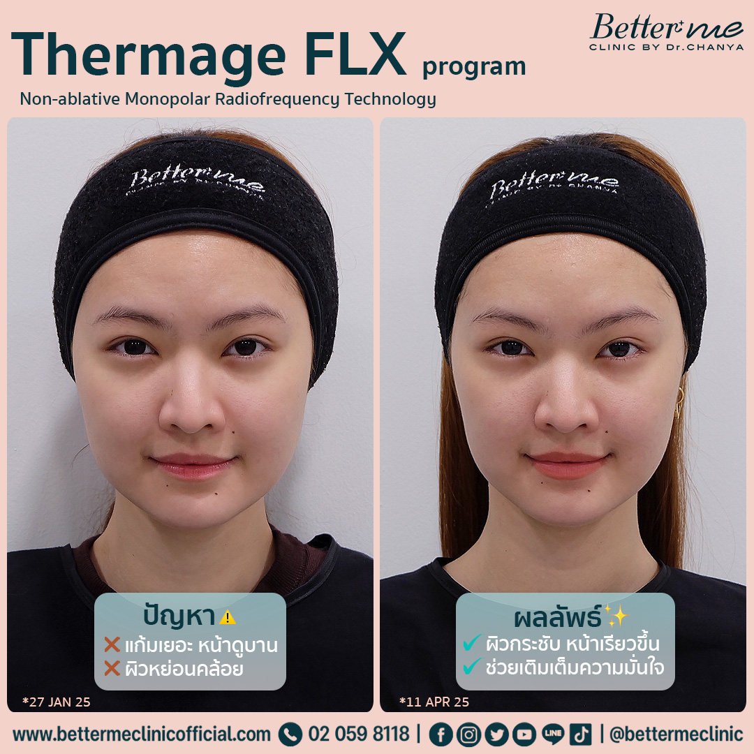 Thermage FLX program