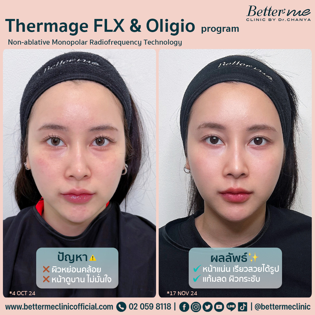 Thermage FLX program