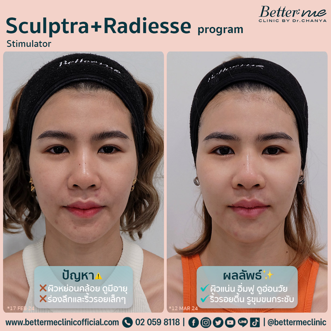 Sculptra program
