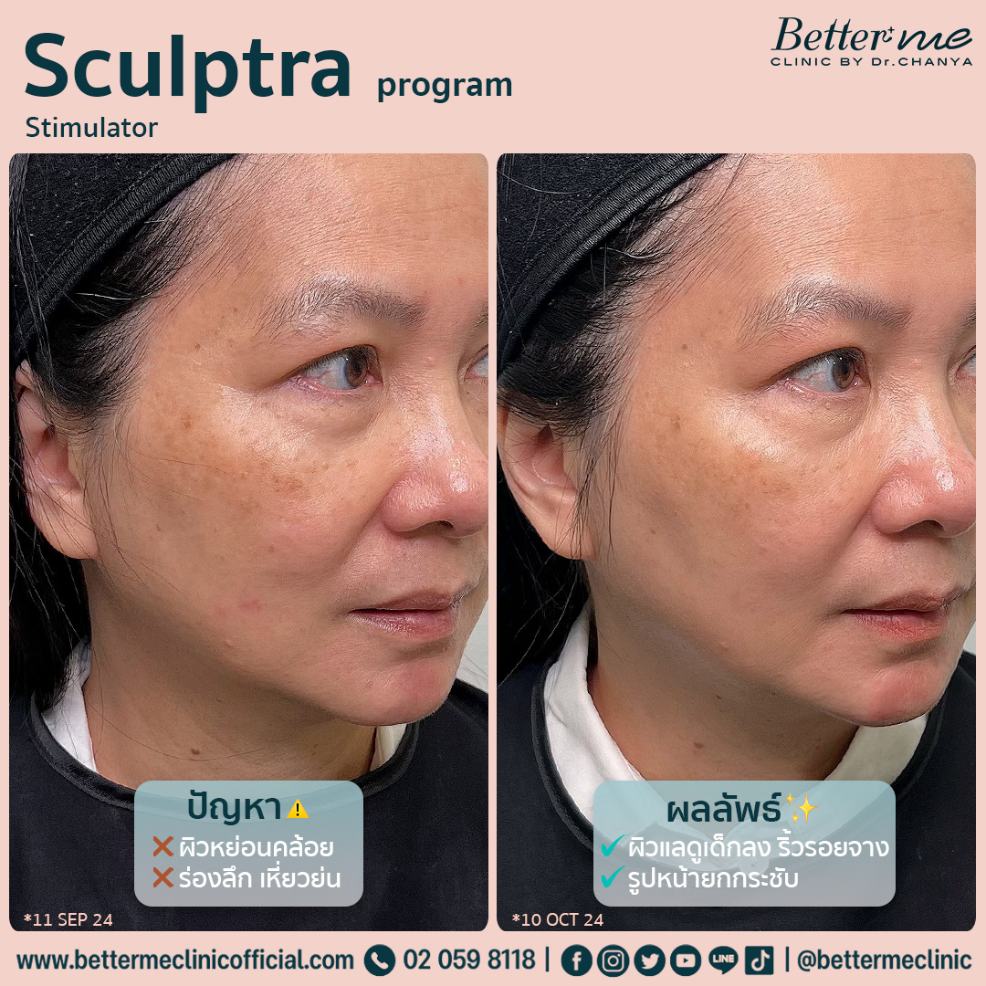 Sculptra program